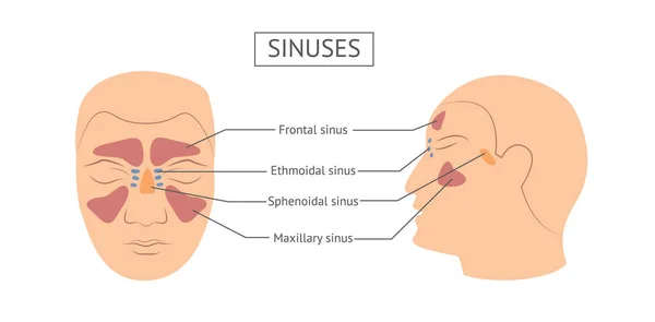Sinusitis pus en variedades de enfermedades de la cavidad nasal y nombres ilustración vectorial . — Vector de stock