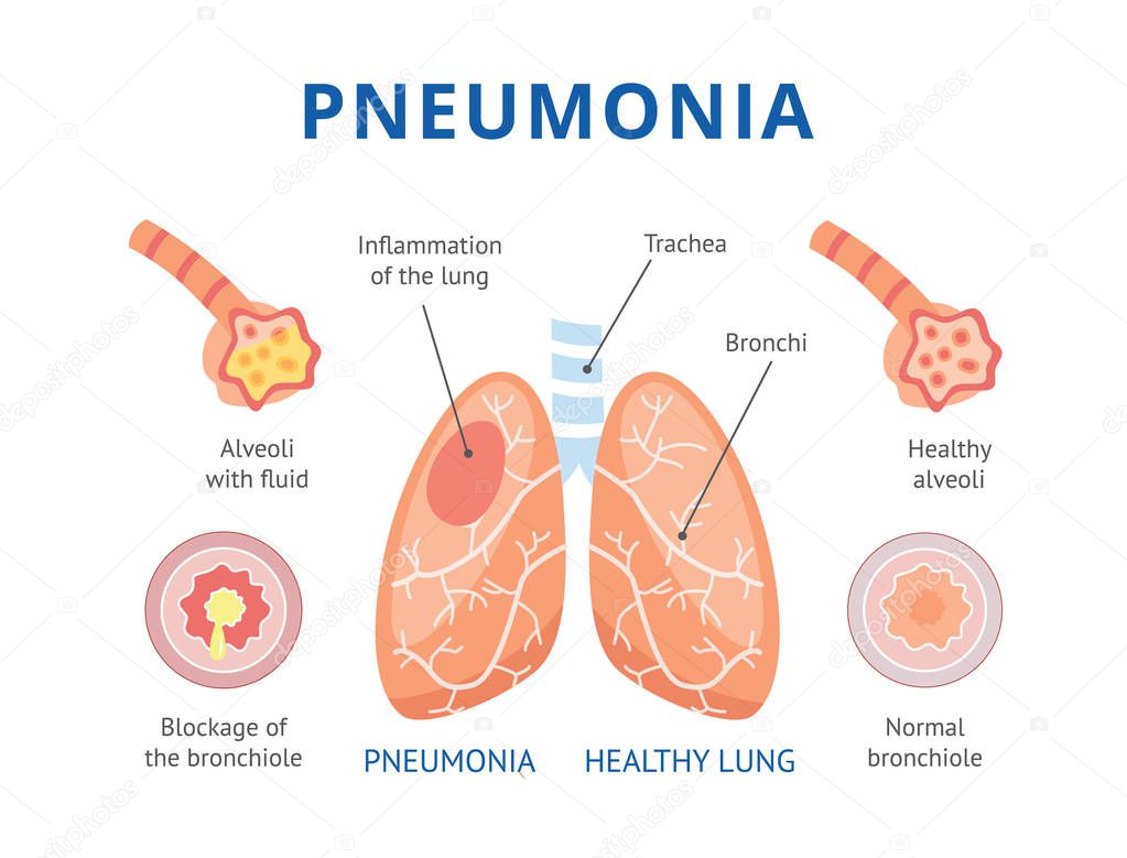 The lungs are healthy and diseased lungs with pneumonia.