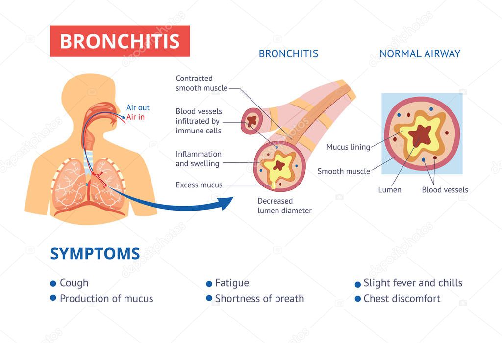 Healthy airway and bronchitis diagnosis symptoms medical banner vector illustration.