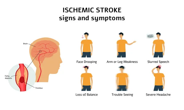 Ischemische beroerte tekenen en symptomen infographic platte vector illustratie geïsoleerd. — Stockvector