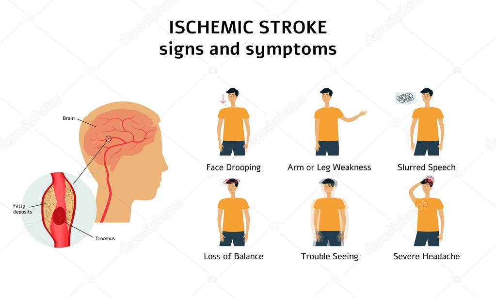 atypical presentation of ischemic stroke