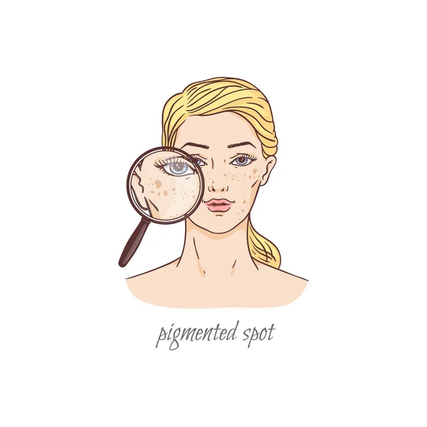 Pigmented spot gezicht huidverzorging probleem - cartoon vrouw met vlekken op haar wangen. — Stockvector