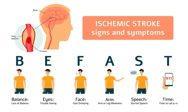 Anzeichen und Symptome eines ischämischen Schlaganfalls - medizinische Infografik des menschlichen Gehirns und des flachen Cartoon Man Set — Stockvektor