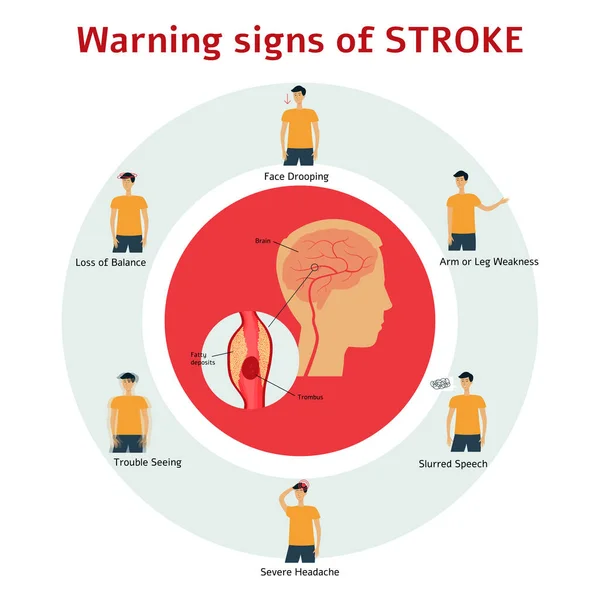 Sinais de alerta de acidente vascular cerebral - infográfico de desenhos animados plano do homem mostrando sintomas de problema de saúde médica —  Vetores de Stock