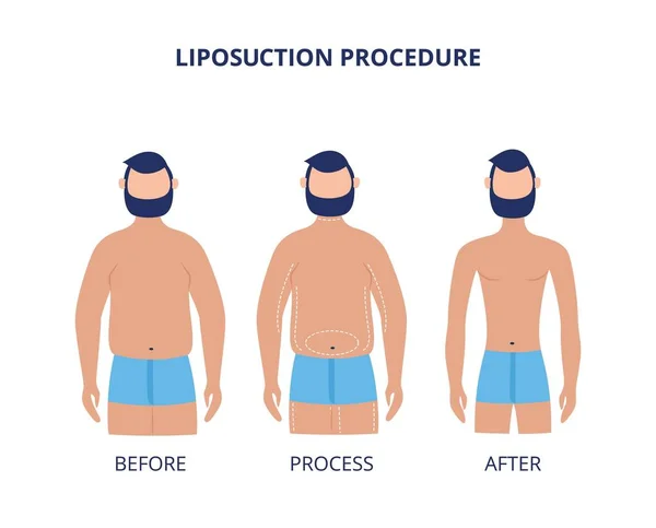 Procédure de liposuccion avant et après - dessin animé homme pendant la chirurgie de perte de poids — Image vectorielle