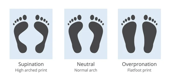 Diagrama de variación del arco del pie: supinación y sobrepronación y huella de suela humana normalmente arqueada — Vector de stock