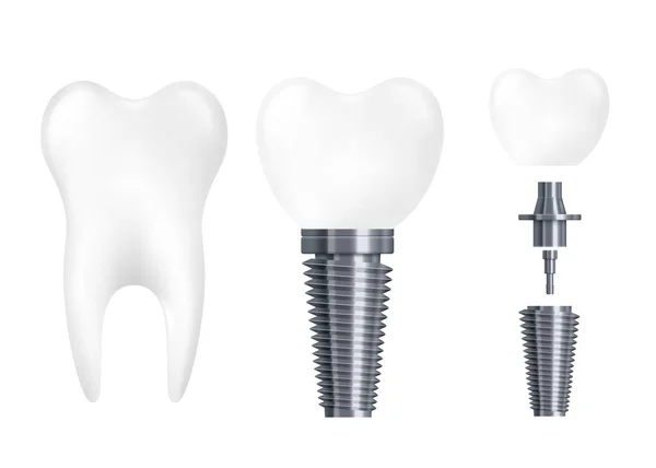 Частини стоматологічного імплантату - реалістичний білий зуб з металевим гвинтом — стоковий вектор