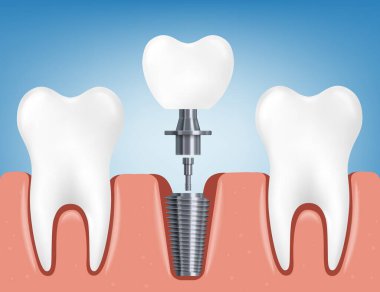 Installing a dental implant a realistic 3D vector illustration clipart