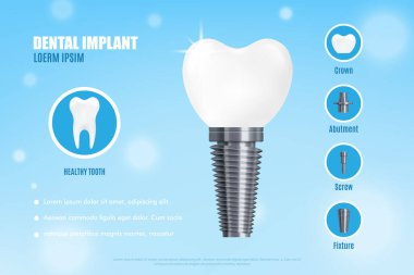 Advertisement poster with realistic 3d vector illustration dental implant structure clipart