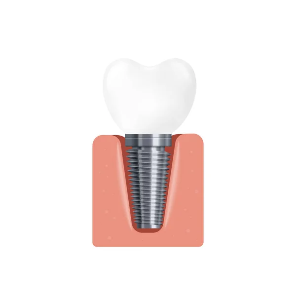 Realistische 3D geïsoleerde vectorillustratie van een tandheelkundig implantaat in het tandvlees — Stockvector