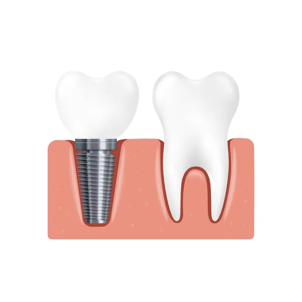 歯のインプラントと通常の歯のリアルなベクトルイラストが分離. — ストックベクタ