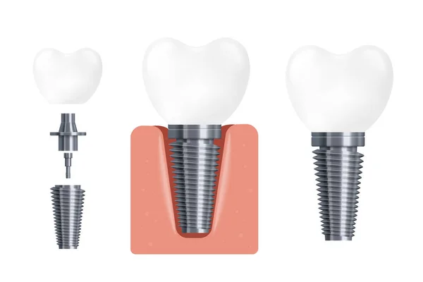 Construção de implantes dentários, ilustração vetorial cartoon plana isolada —  Vetores de Stock