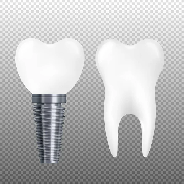 Realistische tandheelkundige implantaat en gezonde tand geïsoleerd op transparante achtergrond. — Stockvector