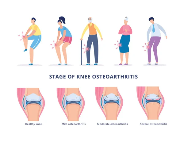 Banner con etapas de osteoartritis de rodilla y personas que sufren de dolor en las piernas — Archivo Imágenes Vectoriales