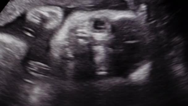 Pequeño Bebé Durante Semanas Girando Vientre Madre Durante Procedimiento Ultrasónico — Vídeos de Stock
