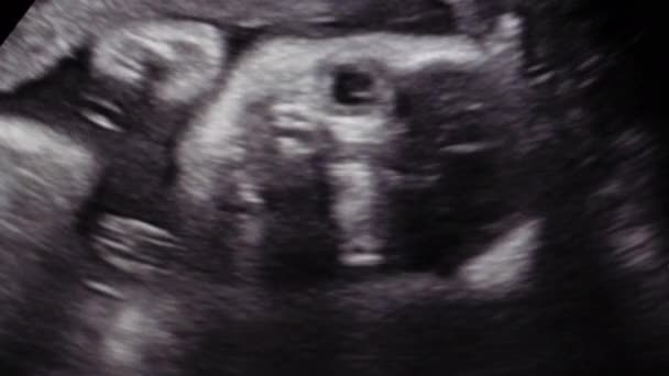 Bebê Minúsculo Durante Semanas Girando Barriga Mãe Durante Procedimento Ultra — Vídeo de Stock