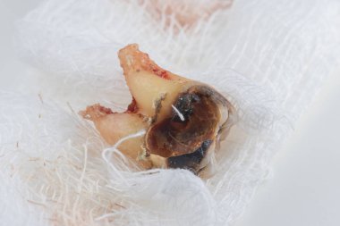 Çürümüş bir diş, bir parça gazlı bezin üzerinde dolgu var.