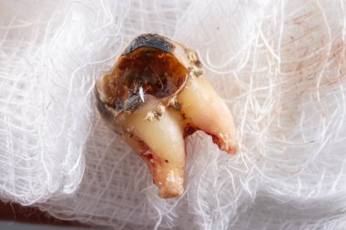 Çürümüş bir diş, bir parça gazlı bezin üzerinde dolgu var.