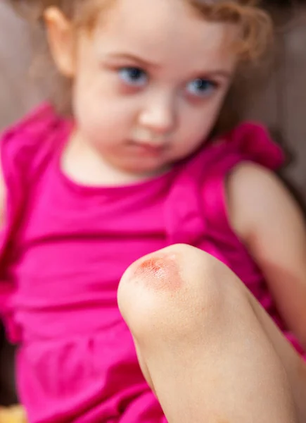 Verwundetes Knie Des Kindes Schürfwunden Den Knien Des Kleinen Mädchens — Stockfoto