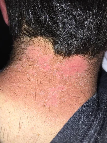 男の首と背中の重度の日焼けから剥離のビュー — ストック写真