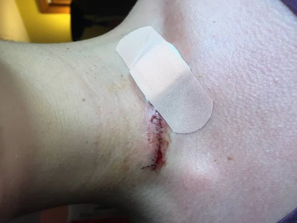 Thyroidectomy scar after surgery due to papillary thyroid cancer with stitches and a bandage covering the open wound from the drain