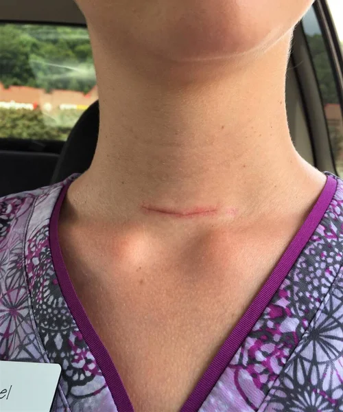 甲状腺乳頭がんによる甲状腺摘出手術による女性の首の治癒傷 — ストック写真