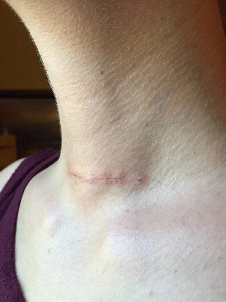 Sebuah Bekas Luka Penyembuhan Leher Seorang Wanita Dari Operasi Tiroidektomi — Stok Foto