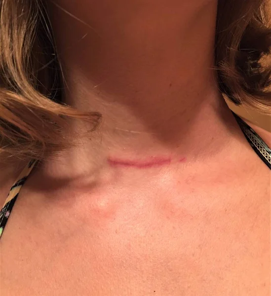 Una Cicatrice Cicatrizzante Sul Collo Una Donna Chirurgia Tiroidectomia Causa — Foto Stock