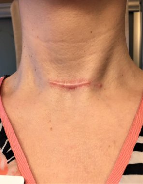 Tiroidektomi ameliyatından kaynaklanan kırmızı, yükseltilmiş hipertrofik ya da keloid bir kadının boynundaki yara izi. 