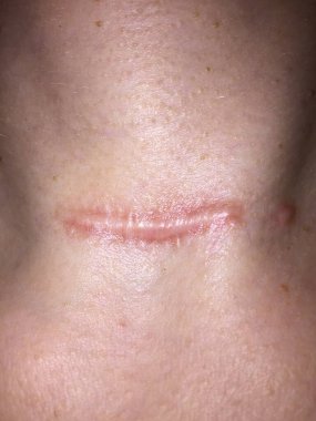 Tiroidektomi ameliyatından kaynaklanan kırmızı, yükseltilmiş hipertrofik ya da keloid bir kadının boynundaki yara izi. 
