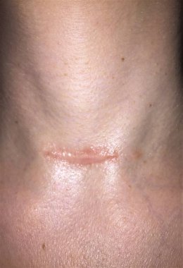 Tiroidektomi ameliyatından bir yıl sonra bir kadının boynunda kırmızı, yükseltilmiş hipertrofik ya da keloid izi var. 