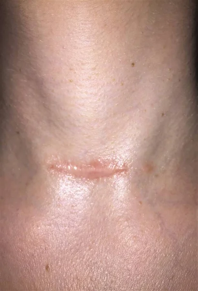 甲状腺摘出手術後1年後 女性の首に赤 ケロイドの傷跡を閉じる — ストック写真
