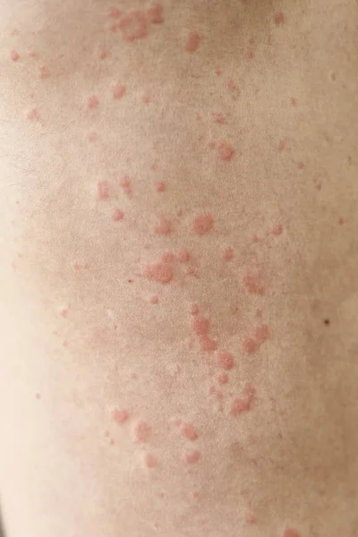 Niedoskonałości skóry. Alergia skórna. Choroba pokrzywki. Czerwone plamy na skórze. — Zdjęcie stockowe