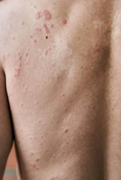Imperfección de la piel. Alergia a la piel. Enfermedad de urticaria. Manchas rojas en la piel . — Foto de Stock
