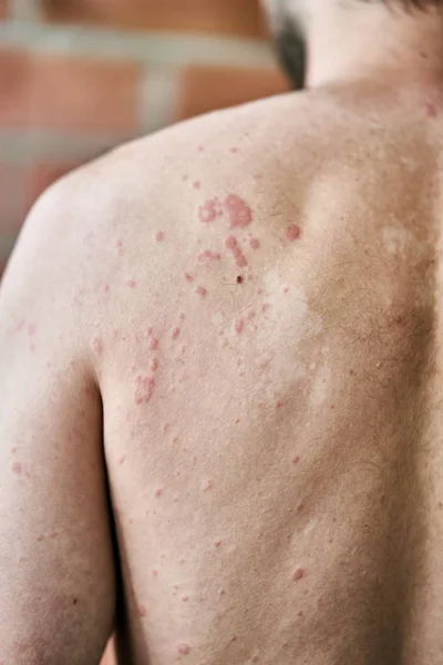 Skin imperfection. Skin allergy. Urticaria disease. Red spots on the skin.