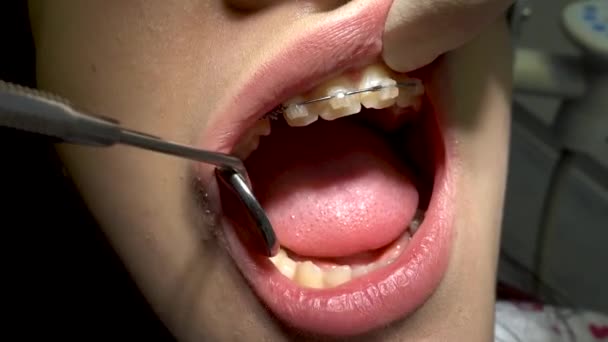 Metal Braces Close Visit Dentist Orthodontist Conducts Inspection — Stock Video