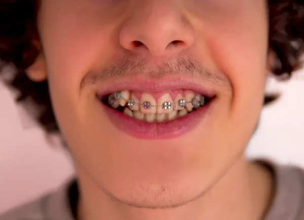 Happy Teen Braces Orthodontics — Stock Photo, Image