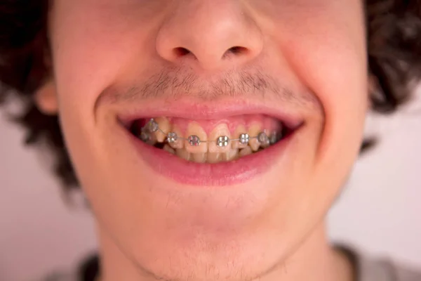 Happy Teen Braces Orthodontics — Stock Photo, Image