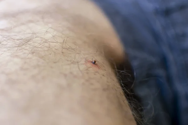 The tick bites the man\'s leg. sucked deep under the skin.