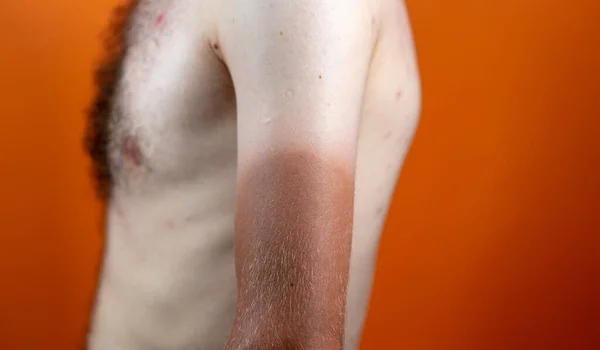 Zbliżenie Człowieka Silną Opalenizną Białe Nagie Męskie Ciało Pół Opalona — Zdjęcie stockowe