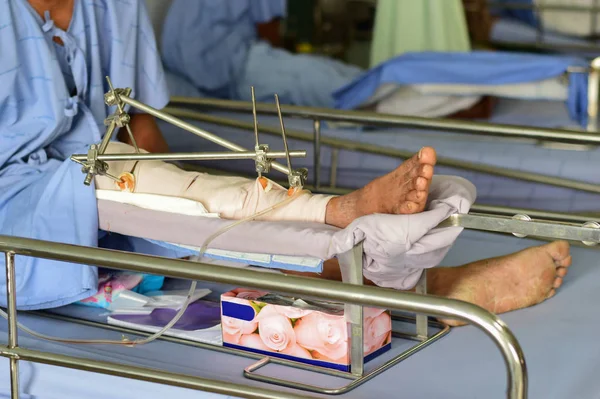 Tratamento Ortopédico Cirurgia Óssea Dos Pacientes Osso Aço — Fotografia de Stock