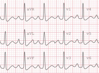 Elektrokardiyogram, Ekg çıktı, Ekg arka plan