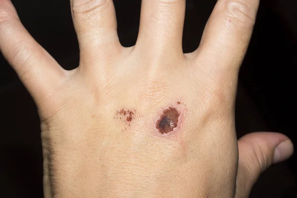 Uma Dolorosa Abrasão Braço Homem Derrubou Osso Mão — Fotografia de Stock
