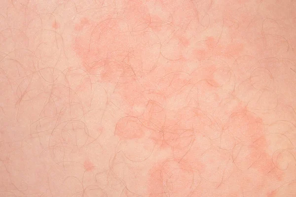 Skin Disease Urticaria Skin Red Spots Itching — Stock Photo, Image