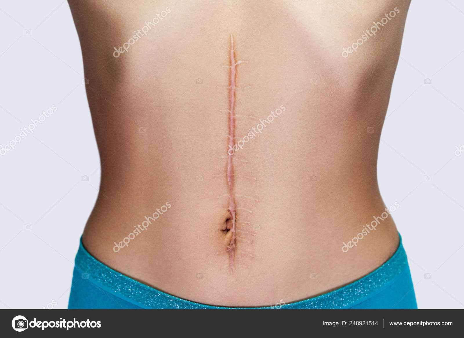 Female Body Large Scar Surgery Abdomen Medical Treatment Scars Removal