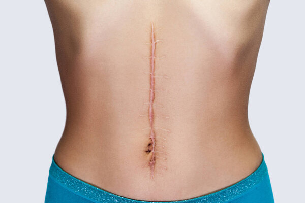 female body with large scar after surgery on abdomen. medical treatment and scars removal concept