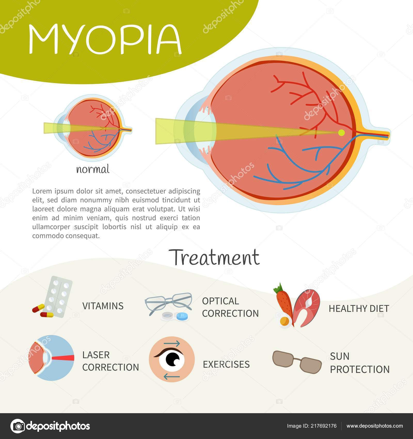 a myopia előfordulása)