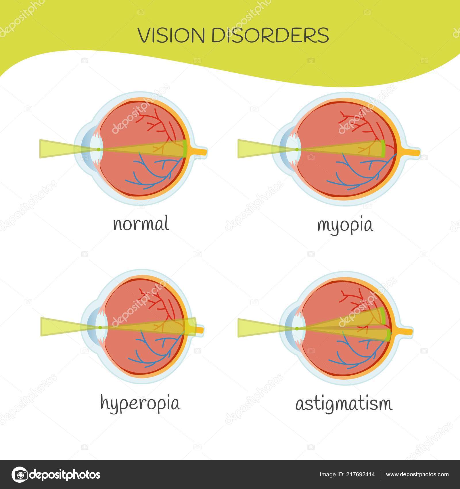 homályos látás és fülfájás helyreállítsa a látásképzést