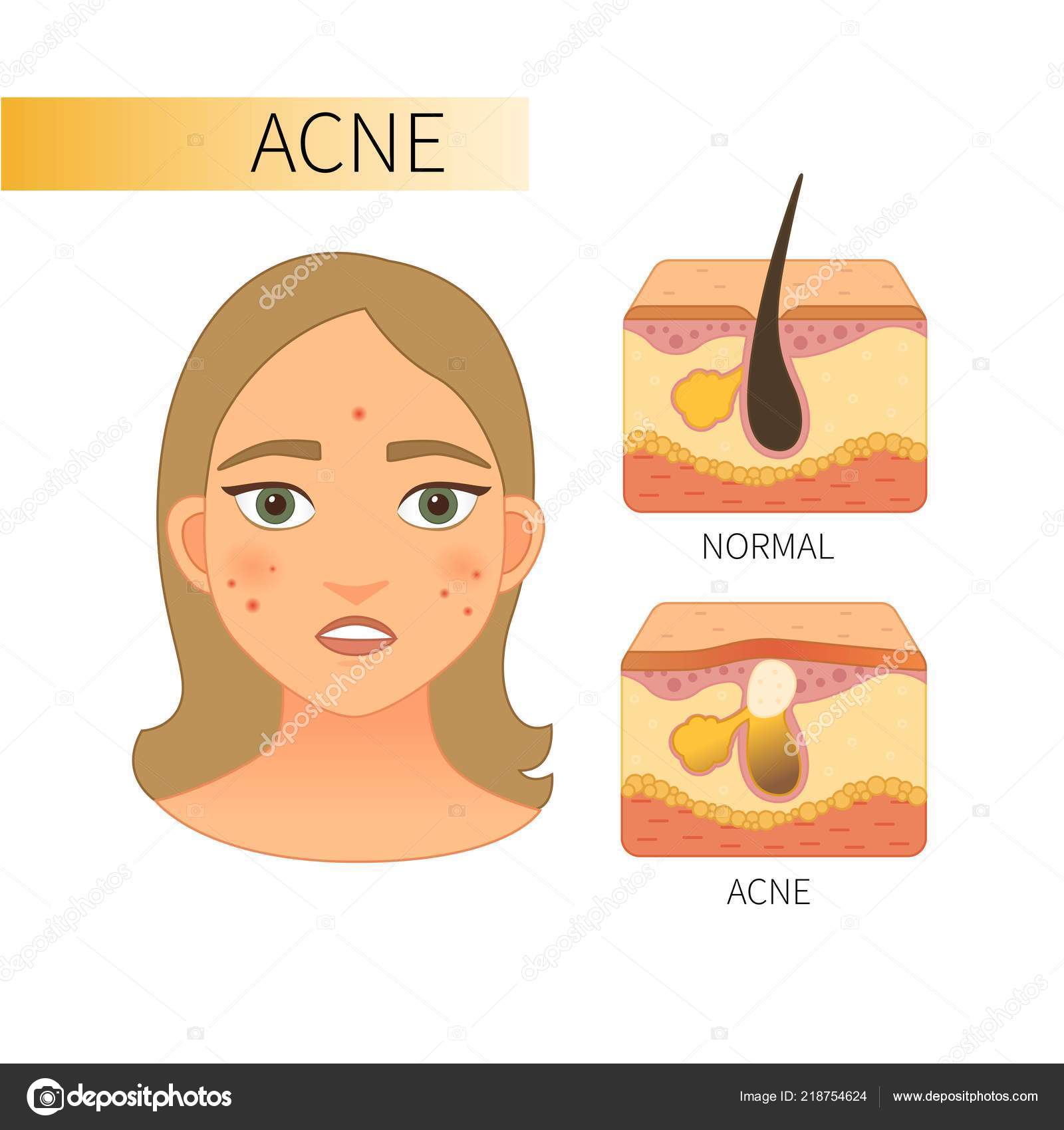 normal skin acne
