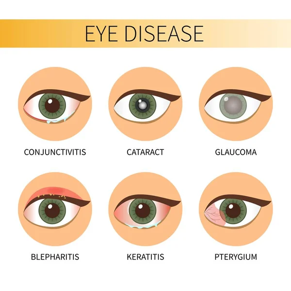 18 Nice Draw a sketch to describe blepharitis for Trend 2022